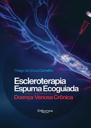 Escleroterapia Com Espuma Ecoguiada