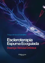 Escleroterapia Com Espuma Ecoguiada