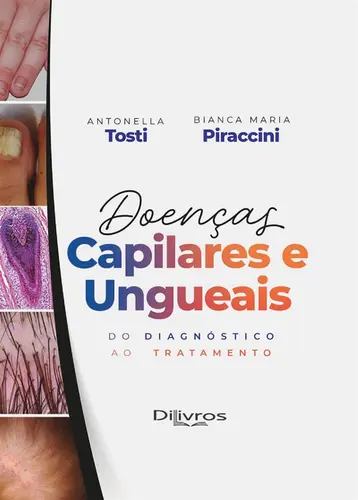 Doenças Capilares E Ungueais: Do Diagnóstico Ao Tratamento