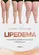Lipedema Perspectivas Atuais Em Condutas E Tratamentos